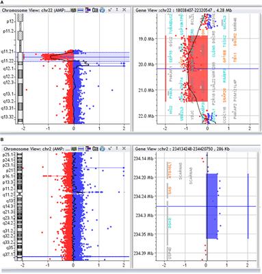 A Case of 22q11 Deletion Syndrome (22q11DS) with a Panayiotopoulos Epileptic Pattern: Are Additional Copy-Number Variations a Possible Second Hit in Modulating the 22q11DS Phenotype?